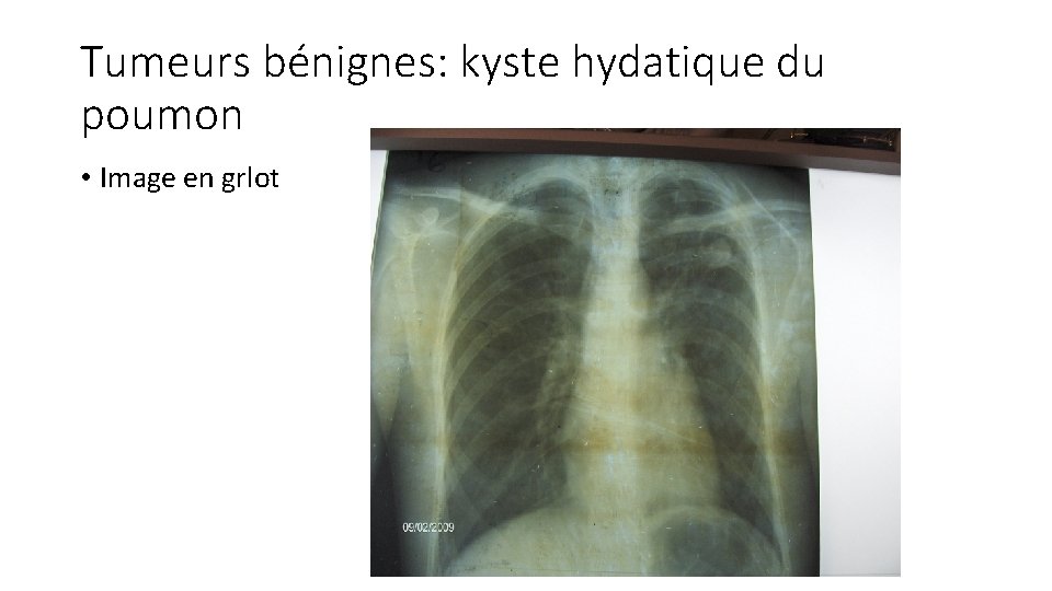 Tumeurs bénignes: kyste hydatique du poumon • Image en grlot 
