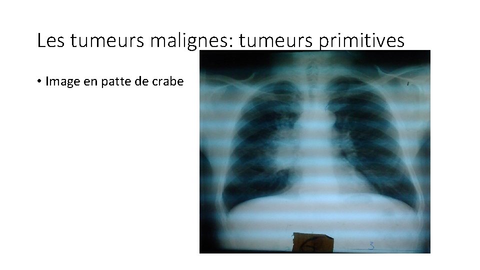 Les tumeurs malignes: tumeurs primitives • Image en patte de crabe 