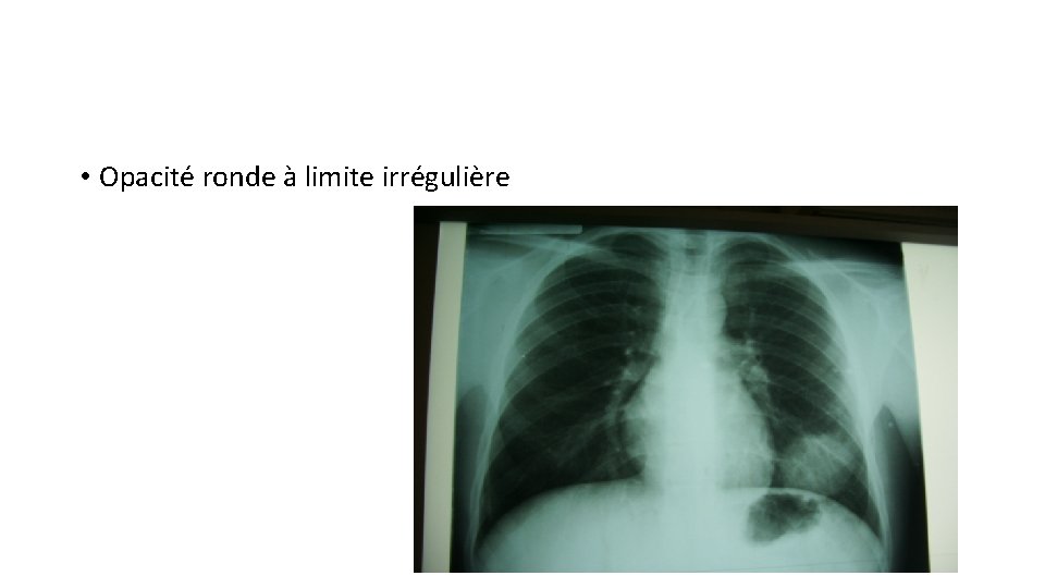  • Opacité ronde à limite irrégulière 