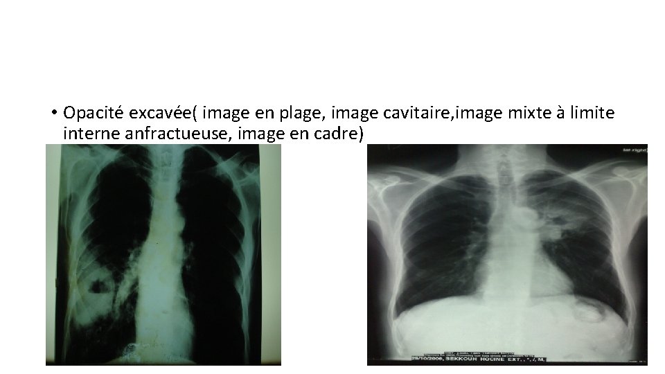  • Opacité excavée( image en plage, image cavitaire, image mixte à limite interne