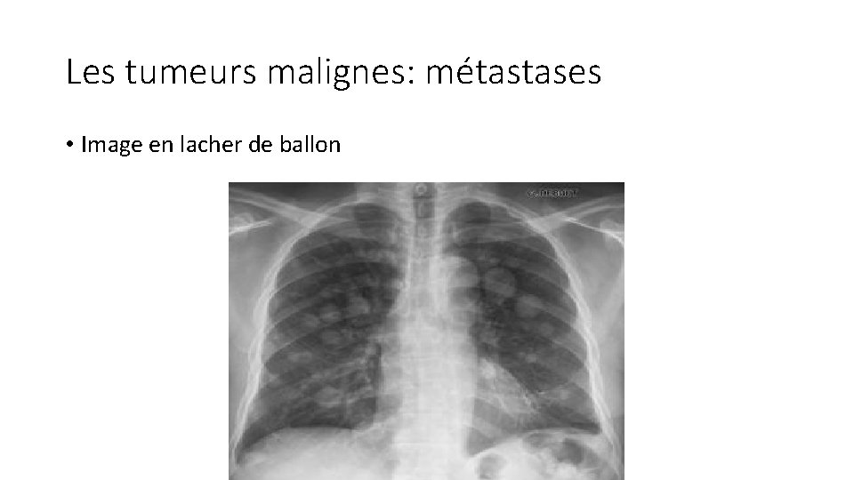 Les tumeurs malignes: métastases • Image en lacher de ballon 