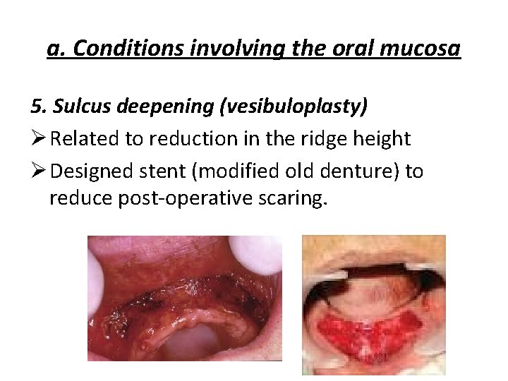 a. Conditions involving the oral mucosa 5. Sulcus deepening (vesibuloplasty) Ø Related to reduction