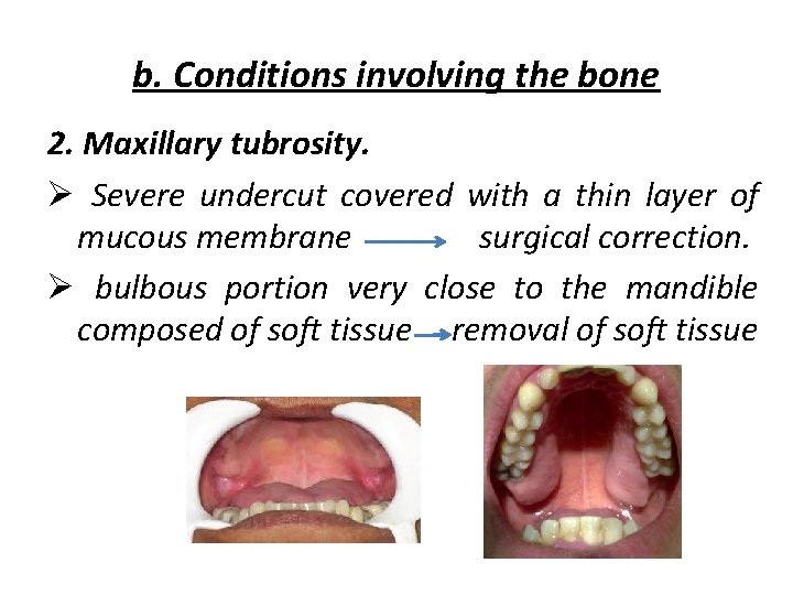 b. Conditions involving the bone 2. Maxillary tubrosity. Ø Severe undercut covered with a