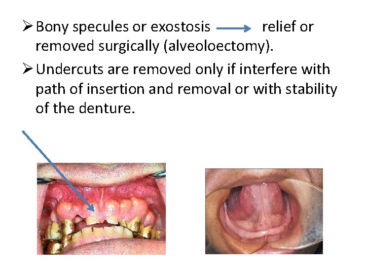 Ø Bony specules or exostosis relief or removed surgically (alveoloectomy). Ø Undercuts are removed
