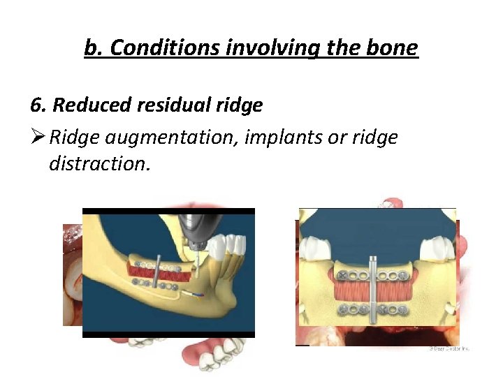 b. Conditions involving the bone 6. Reduced residual ridge Ø Ridge augmentation, implants or