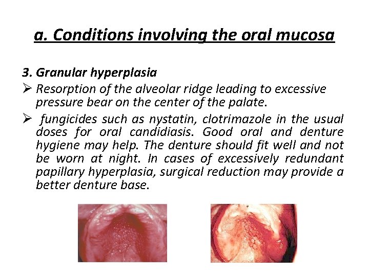 a. Conditions involving the oral mucosa 3. Granular hyperplasia Ø Resorption of the alveolar