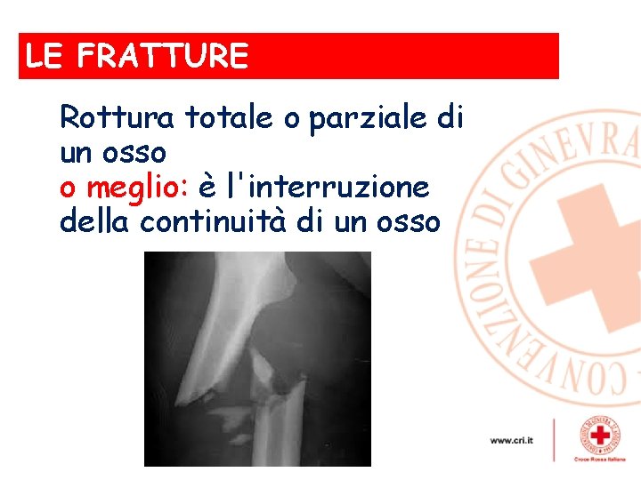 LE FRATTURE , Rottura totale o parziale di un osso o meglio: è l'interruzione