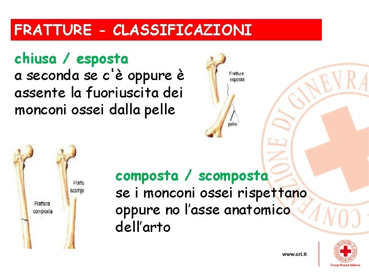 FRATTURE - CLASSIFICAZIONI , chiusa / esposta a seconda se c'è oppure è assente