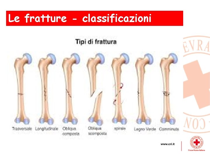 Le fratture - classificazioni , 
