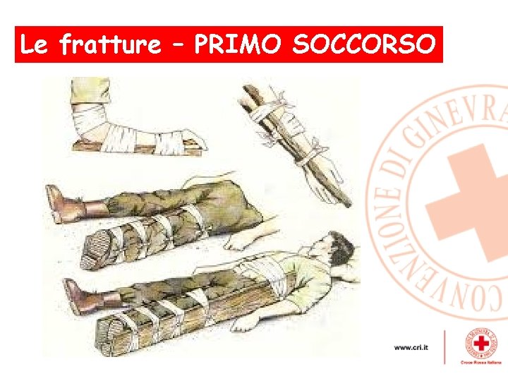 Le fratture – PRIMO , SOCCORSO 