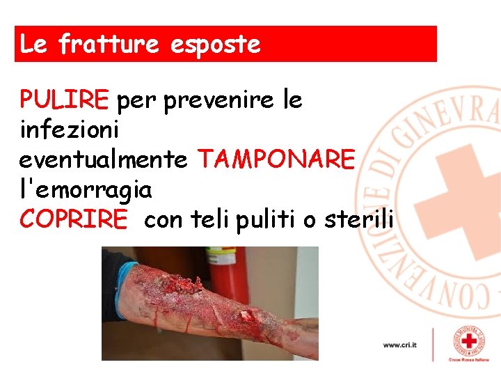 Le fratture esposte , PULIRE per prevenire le infezioni eventualmente TAMPONARE l'emorragia COPRIRE con