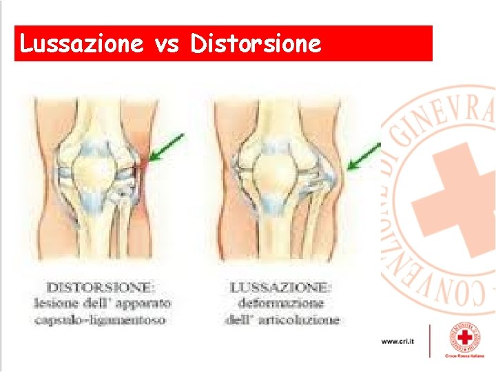 Lussazione vs Distorsione , 