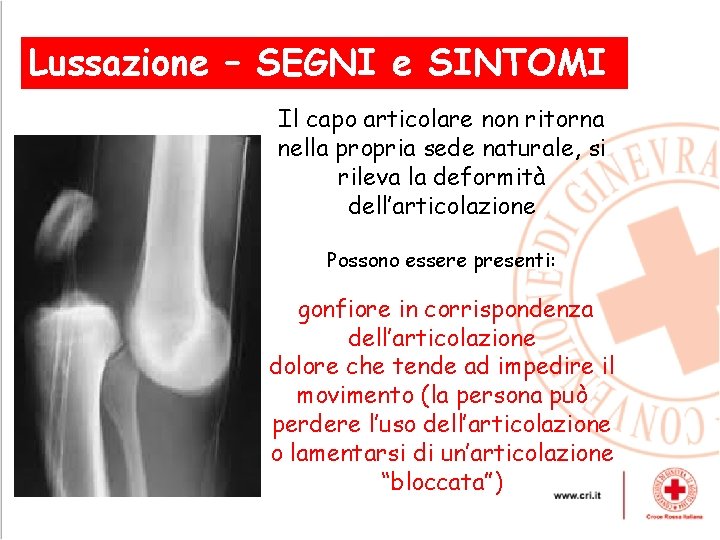 Lussazione – SEGNI , e SINTOMI Il capo articolare non ritorna nella propria sede