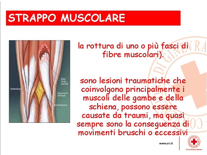 STRAPPO MUSCOLARE , la rottura di uno o più fasci di fibre muscolari). sono