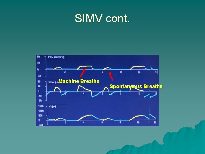 SIMV cont. Machine Breaths Spontaneous Breaths 
