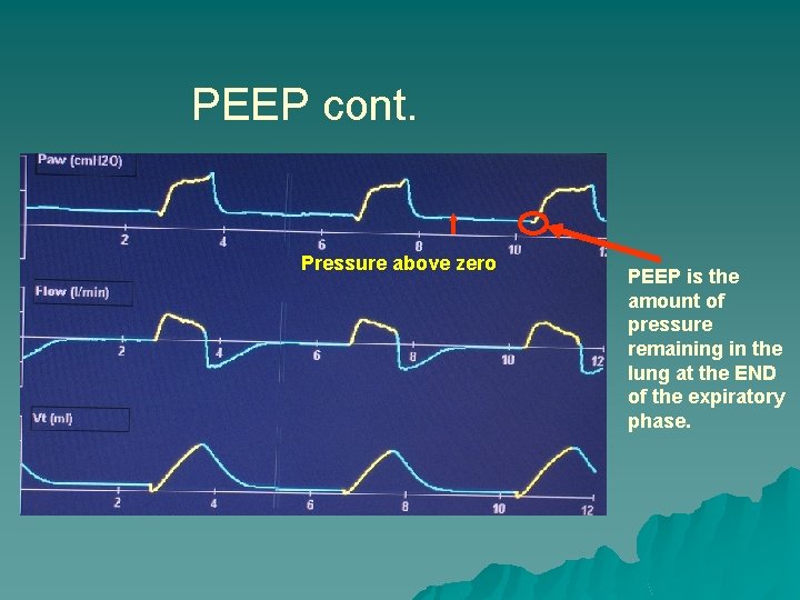 PEEP cont. Pressure above zero PEEP is the amount of pressure remaining in the