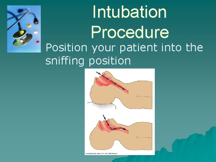 Intubation Procedure Position your patient into the sniffing position 