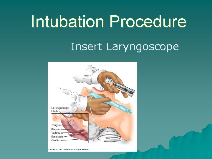 Intubation Procedure Insert Laryngoscope 