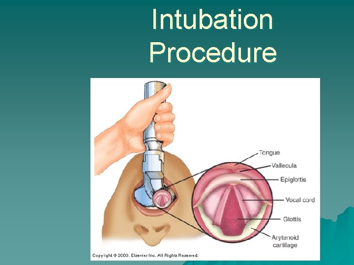 Intubation Procedure 
