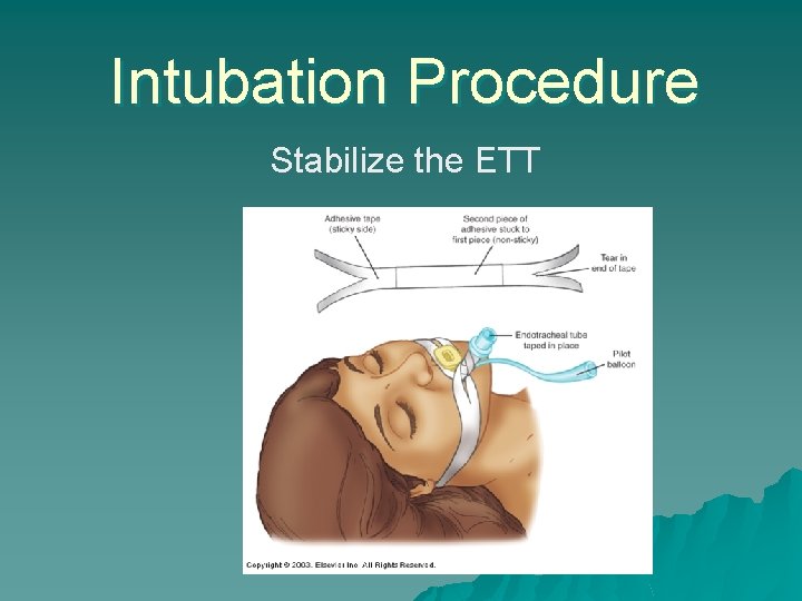 Intubation Procedure Stabilize the ETT 