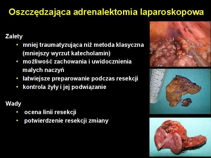 Oszczędzająca adrenalektomia laparoskopowa Zalety • mniej traumatyzująca niż metoda klasyczna (mniejszy wyrzut katecholamin) •