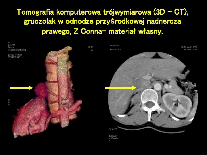 Tomografia komputerowa trójwymiarowa (3 D – CT), gruczolak w odnodze przyśrodkowej nadnercza prawego, Z