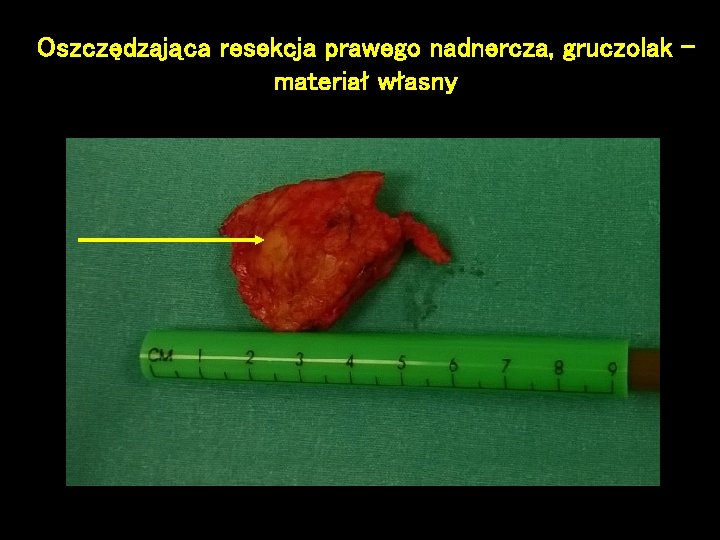 Oszczędzająca resekcja prawego nadnercza, gruczolak – materiał własny 