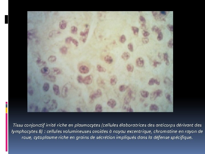 Tissu conjonctif irrité riche en plasmocytes (cellules élaboratrices des anticorps dérivant des lymphocytes B)