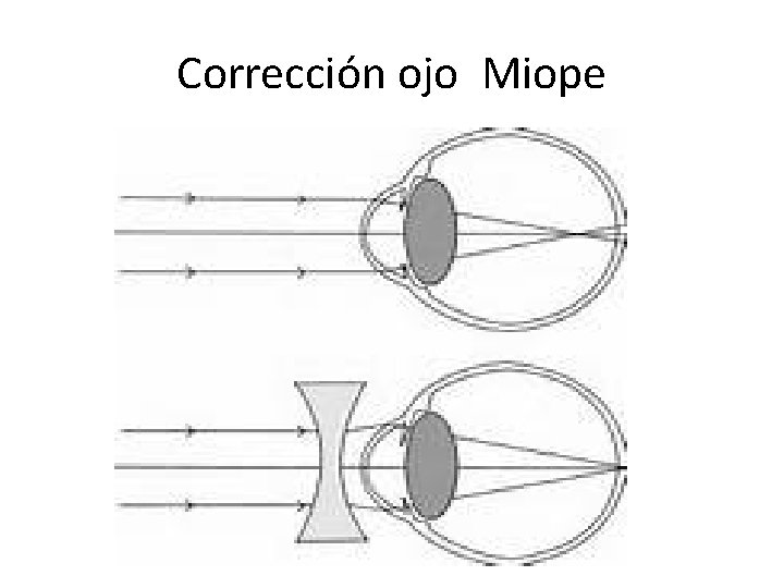 Corrección ojo Miope 