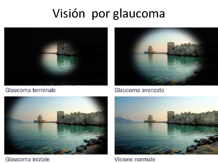 Visión por glaucoma 