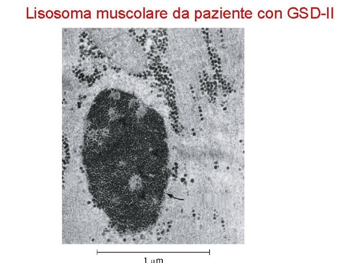 Lisosoma muscolare da paziente con GSD-II 