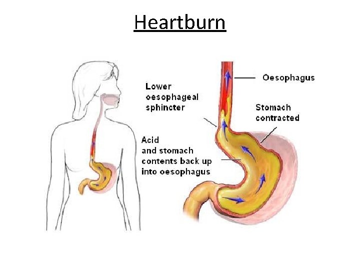 Heartburn 