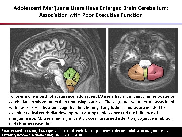 Adolescent Marijuana Users Have Enlarged Brain Cerebellum: Association with Poor Executive Function Following one Adolescent Marijuana Users Have Enlarged Brain Cerebellum: Association with Poor Executive Function Following one