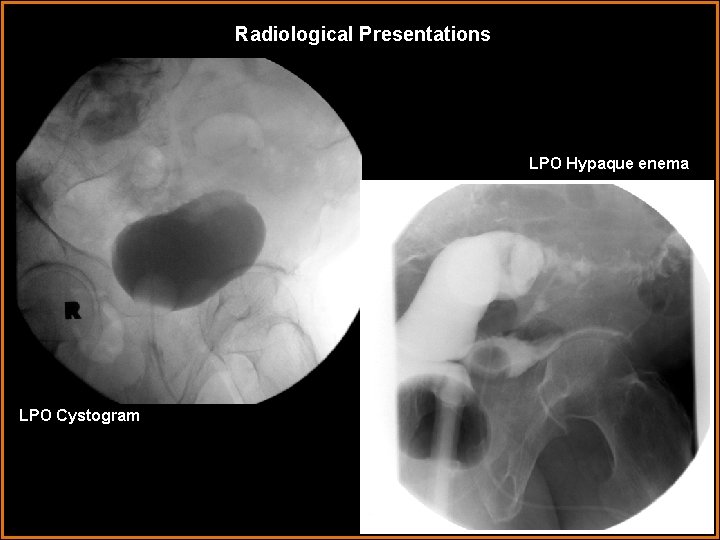 Radiological Presentations LPO Hypaque enema LPO Cystogram 