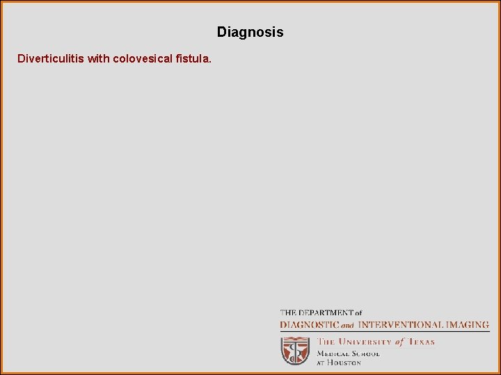 Diagnosis Diverticulitis with colovesical fistula. 