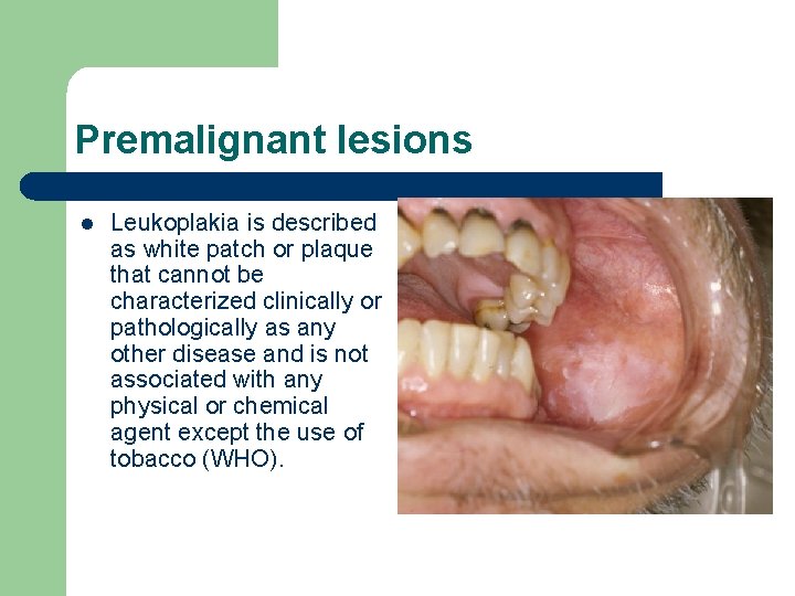 Premalignant lesions l Leukoplakia is described as white patch or plaque that cannot be Premalignant lesions l Leukoplakia is described as white patch or plaque that cannot be