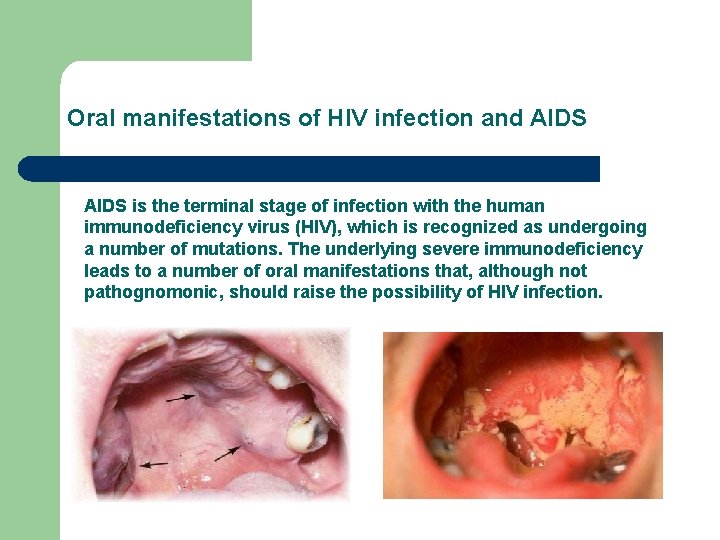 Oral manifestations of HIV infection and AIDS is the terminal stage of infection with Oral manifestations of HIV infection and AIDS is the terminal stage of infection with