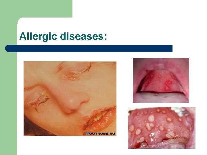 Allergic diseases: Allergic diseases:
