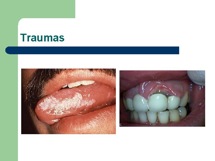 Traumas Traumas