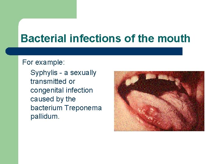 Bacterial infections of the mouth For example: Syphylis - a sexually transmitted or congenital Bacterial infections of the mouth For example: Syphylis - a sexually transmitted or congenital