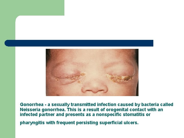 Gonorrhea - a sexually transmitted infection caused by bacteria called Neisseria gonorrhea. This is Gonorrhea - a sexually transmitted infection caused by bacteria called Neisseria gonorrhea. This is