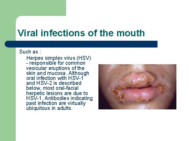 Viral infections of the mouth Such as : Herpes simplex virus (HSV) - responsible Viral infections of the mouth Such as : Herpes simplex virus (HSV) - responsible