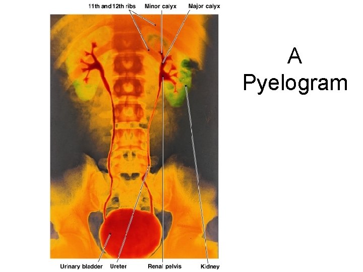 A Pyelogram Figure 26– 17 