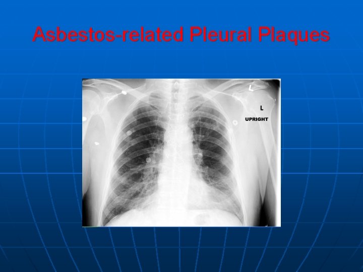 Asbestos-related Pleural Plaques Asbestos-related Pleural Plaques