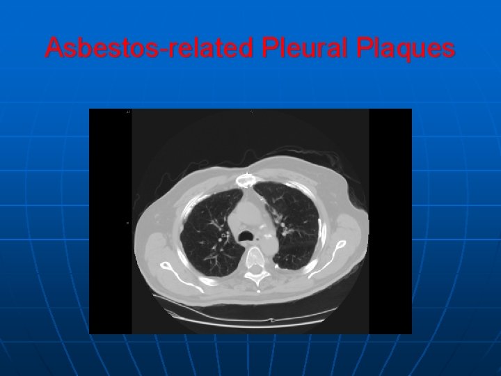 Asbestos-related Pleural Plaques Asbestos-related Pleural Plaques