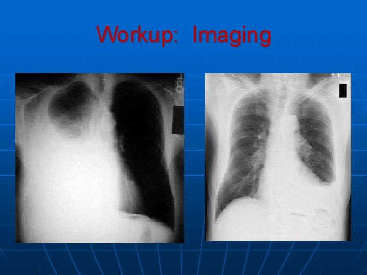 Workup: Imaging Workup: Imaging