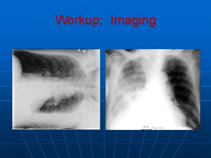 Workup: Imaging Workup: Imaging