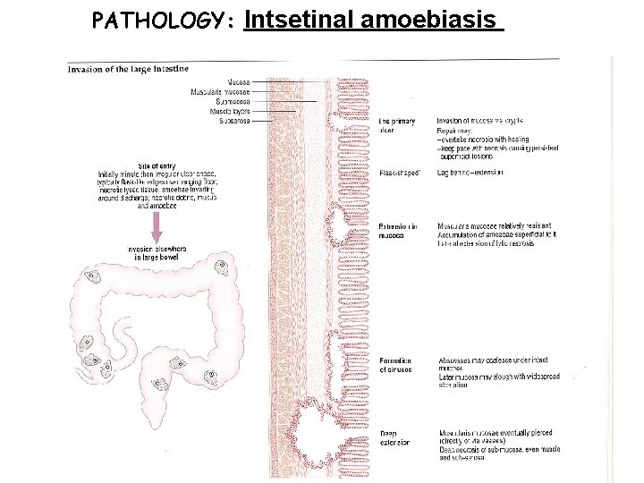 PATHOLOGY: Intsetinal amoebiasis PATHOLOGY: Intsetinal amoebiasis