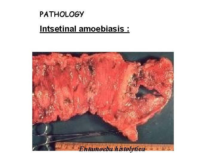 PATHOLOGY Intsetinal amoebiasis : Entamoeba histolytica PATHOLOGY Intsetinal amoebiasis : Entamoeba histolytica