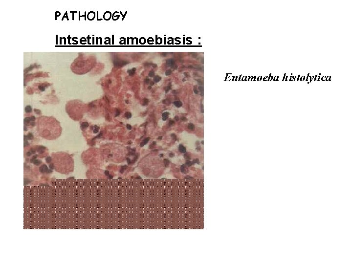 PATHOLOGY Intsetinal amoebiasis : Entamoeba histolytica PATHOLOGY Intsetinal amoebiasis : Entamoeba histolytica